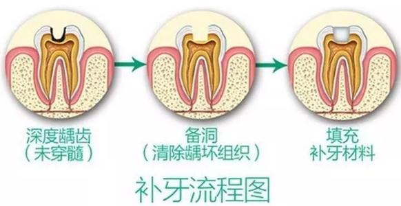 有些补牙，为啥不能一次完成