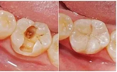 有些补牙，为啥不能一次完成？