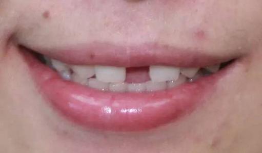 牙齿有缝怎么办？
