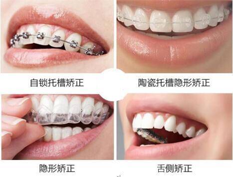 牙缝大的修复方式？