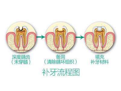 有蛀牙可以不补吗？