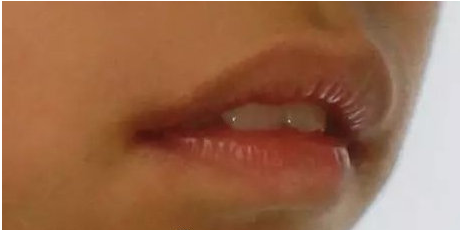 小孩咬嘴唇怎么办？