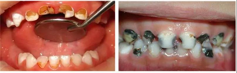 孩子有虫牙怎么办？