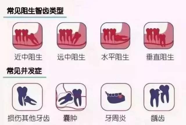兰州智齿疼，到底该不该拔牙？