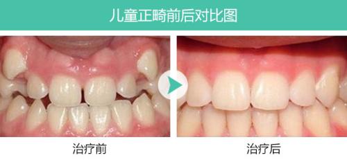 孩子做矫正，家长应该注意什么