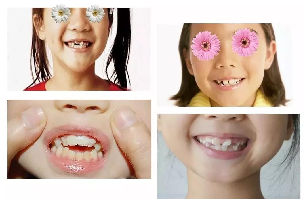 孩子多大后可以做矫正，一定要等到换牙以后吗？