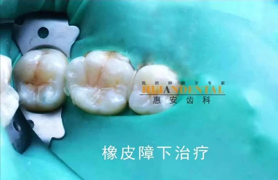 兰州补牙哪里好？