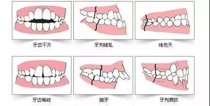 那种牙齿需要矫正？
