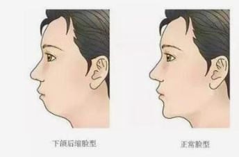 下巴后缩怎么办？